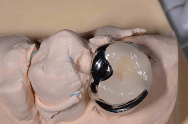 Mary Anne Salcetti Fabricating a Crown to an Existing Removable Partial Denture Figure 7