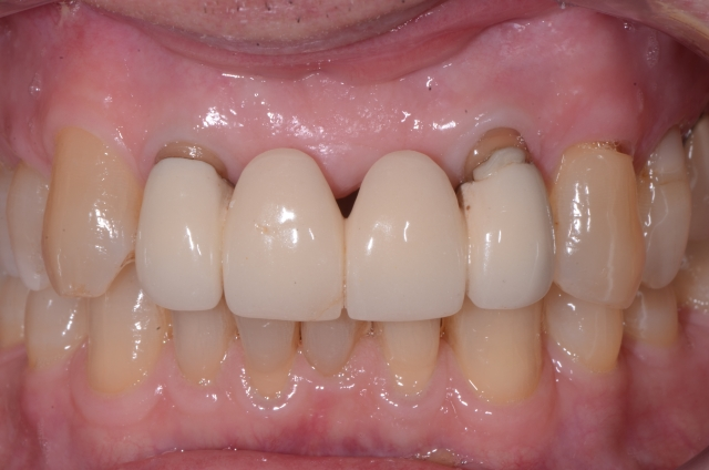 Pontic Design Considerations: A Comprehensive Review Mary Anne Salcetti Pontic Design Considerations Figure 1