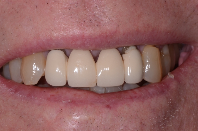 Pontic Design Considerations: A Comprehensive Review Mary Anne Salcetti Pontic Design Considerations Figure 2