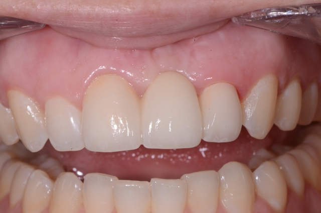 Pontic Design Considerations: A Comprehensive Review Mary Anne Salcetti Pontic Design Considerations Figure 3