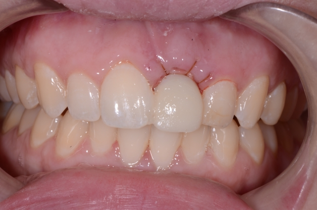 Pontic Design Considerations: A Comprehensive Review Mary Anne Salcetti Pontic Design Considerations Figure 4