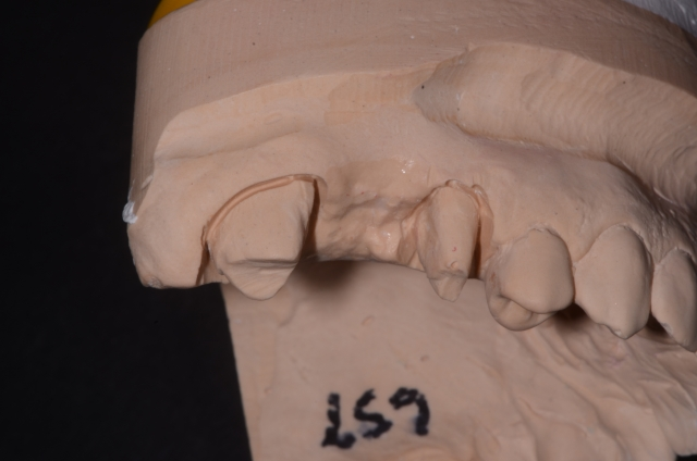 Pontic Design Considerations: A Comprehensive Review Mary Anne Salcetti Pontic Design Considerations Figure 5