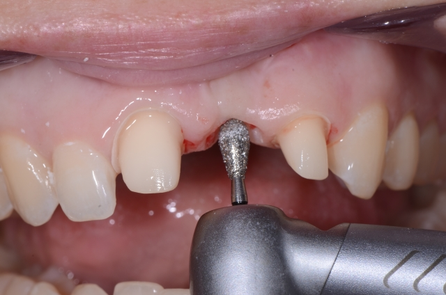 Pontic Design Considerations: A Comprehensive Review Mary Anne Salcetti Pontic Design Considerations Figure 6