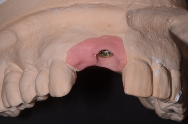 Pontic Design Considerations: A Comprehensive Review Mary Anne Salcetti Pontic Design Considerations Figure 7