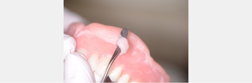 MaryAnneSalcetti PrimerSoftDentureLiners Fig.4