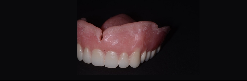 MaryAnneSalcetti PrimerSoftDentureLiners Fig.6