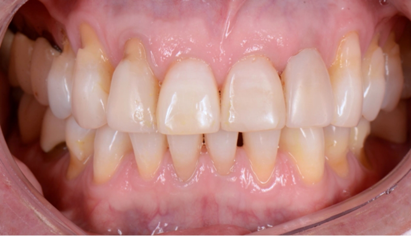 Non-Carious Cervical Lesions (NCCL): Causes and Contributing Factors MelissaSeibert Non Carious Cervical Lesions Fig.1