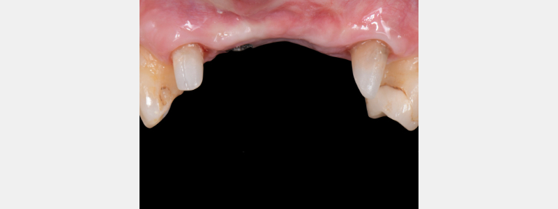 Using a Laser for Implant Uncovery Mitrani laser implant recovery 01