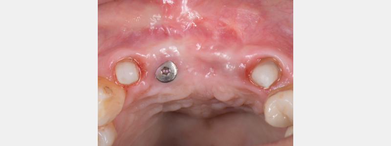 Using a Laser for Implant Uncovery Mitrani laser implant recovery 02