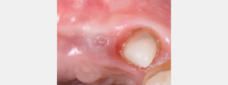 Using a Laser for Implant Uncovery Mitrani laser implant recovery 03