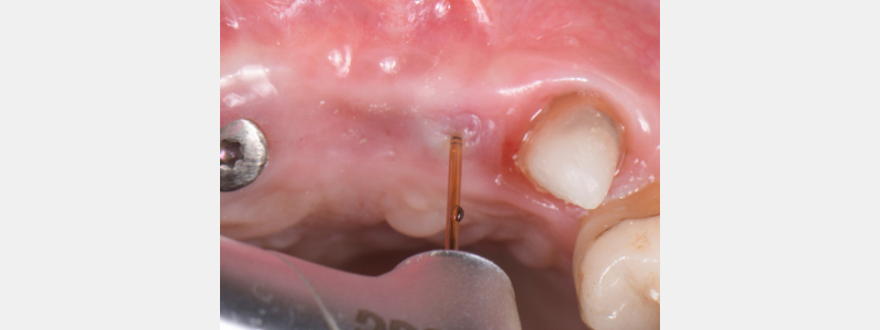 Using a Laser for Implant Uncovery Mitrani laser implant recovery 04