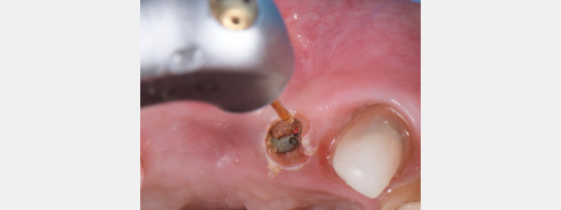 Using a Laser for Implant Uncovery Mitrani laser implant recovery 05