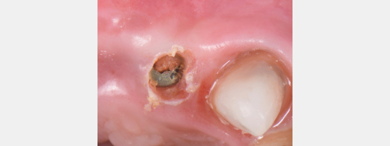 Using a Laser for Implant Uncovery Mitrani laser implant recovery 06