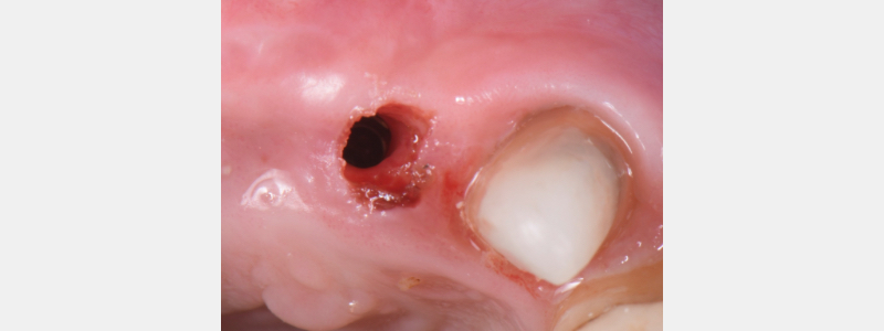 Using a Laser for Implant Uncovery Mitrani laser implant recovery 07