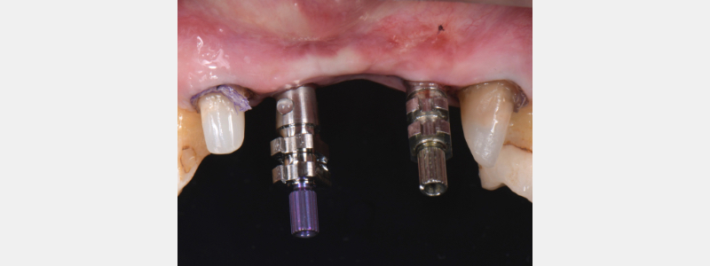 Using a Laser for Implant Uncovery Mitrani laser implant recovery 08