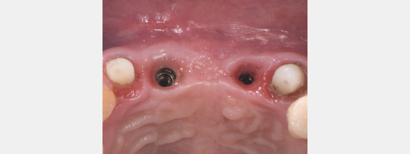 Using a Laser for Implant Uncovery Mitrani laser implant recovery 09