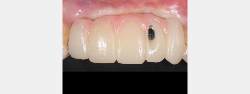 Using a Laser for Implant Uncovery Mitrani laser implant recovery 10