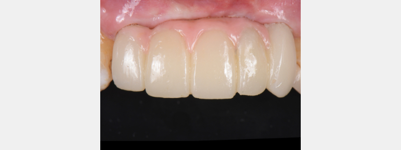 Using a Laser for Implant Uncovery Mitrani laser implant recovery 11