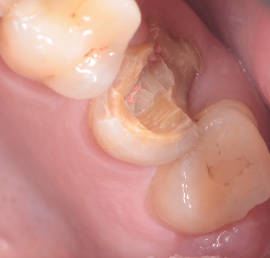 My Tooth Broke As I Was Eating Soft Bread Mitrani softbread 01