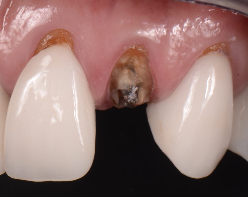 My Tooth Broke As I Was Eating Soft Bread Mitrani softbread 03