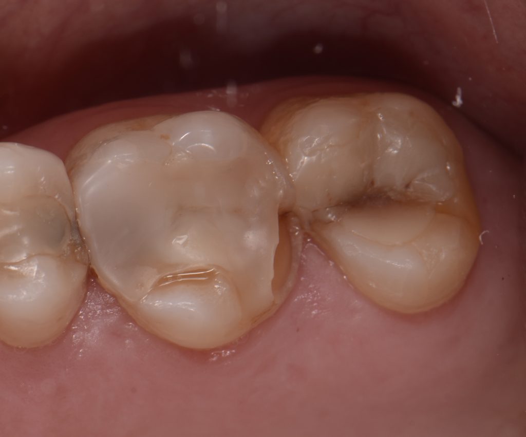 My Tooth Broke As I Was Eating Soft Bread Mitrani softbread 06