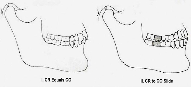 Centric Relation to Maximum Intercuspation Slide, Part 1 Puneet Sandhu Centric Relation to Maximum Intercuspation Slide Part 1 picture 1