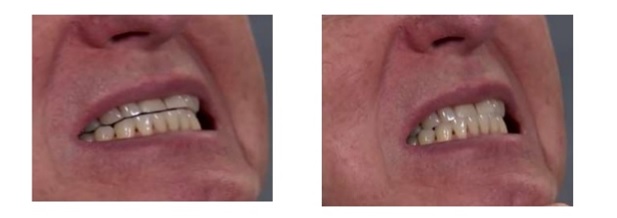 Centric Relation to Maximum Intercuspation Slide, Part 1 Puneet Sandhu Centric Relation to Maximum Intercuspation Slide Part 1 picture 2