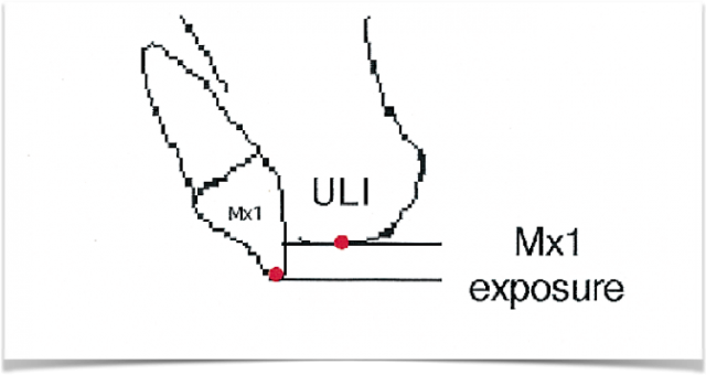 Ideal Position of the Central Incisor Rebecca Bockow Ideal Position of the Central Incisor fig 1