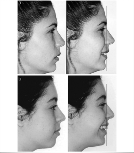 Ideal Position of the Central Incisor Rebecca Bockow Ideal Position of the Central Incisor fig 2