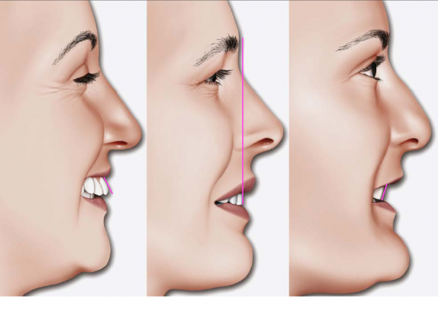Ideal Position of the Central Incisor Rebecca Bockow Ideal Position of the Central Incisor fig 3