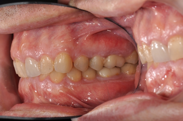 Ideal Position of the Central Incisor Rebecca Bockow Ideal Position of the Central Incisor fig 4