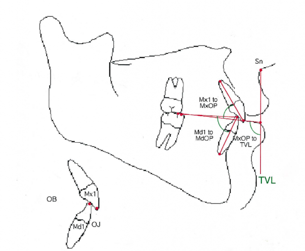 Ideal Position of the Central Incisor Rebecca Bockow Ideal Position of the Central Incisor fig 6