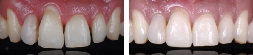 Ricardo Mitrani Battling the Dental Overtreatment Figure 10