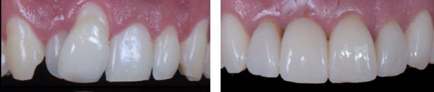 Ricardo Mitrani Battling the Dental Overtreatment Figure 12
