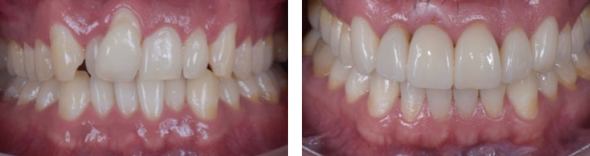 Ricardo Mitrani Battling the Dental Overtreatment Figure 13