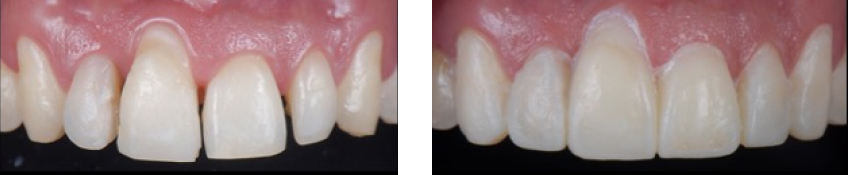Ricardo Mitrani Battling the Dental Overtreatment Figure 8