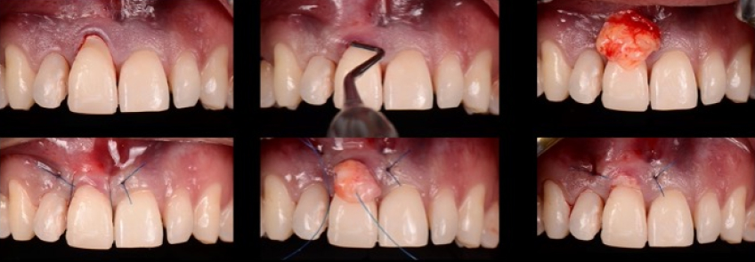 Ricardo Mitrani Battling the Dental Overtreatment Figure 9