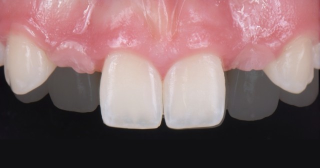 Spear Digest RicardoMitrani 3SolutionsCongenitallyMissingLats FeaturedImage