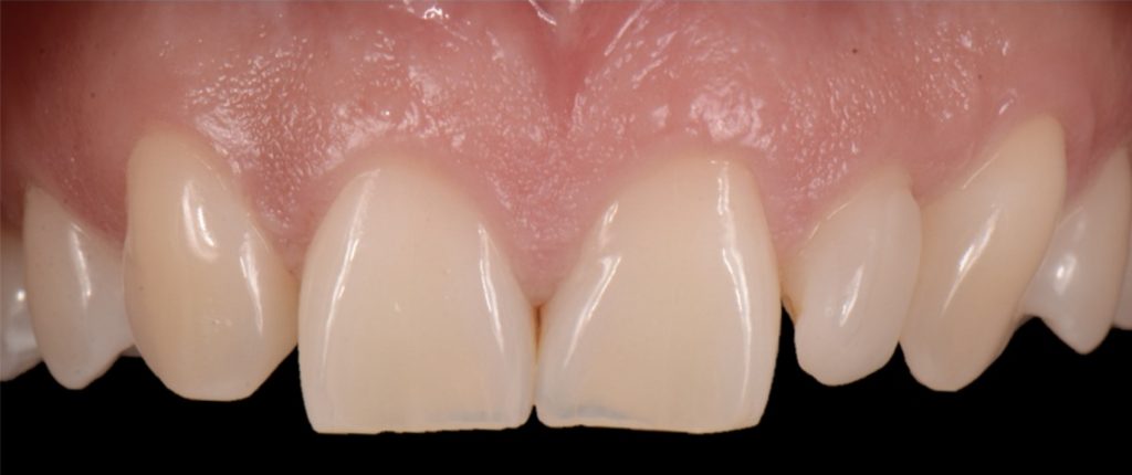 Three Solutions for Congenitally Missing Lateral Incisors: A Photo Essay RicardoMitrani 3SolutionsCongenitallyMissingLats Fig.1