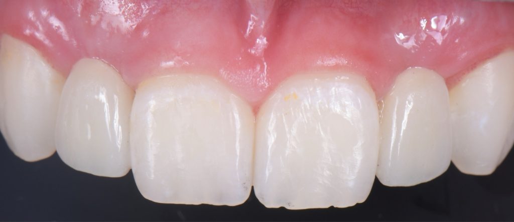 Three Solutions for Congenitally Missing Lateral Incisors: A Photo Essay RicardoMitrani 3SolutionsCongenitallyMissingLats Fig.10
