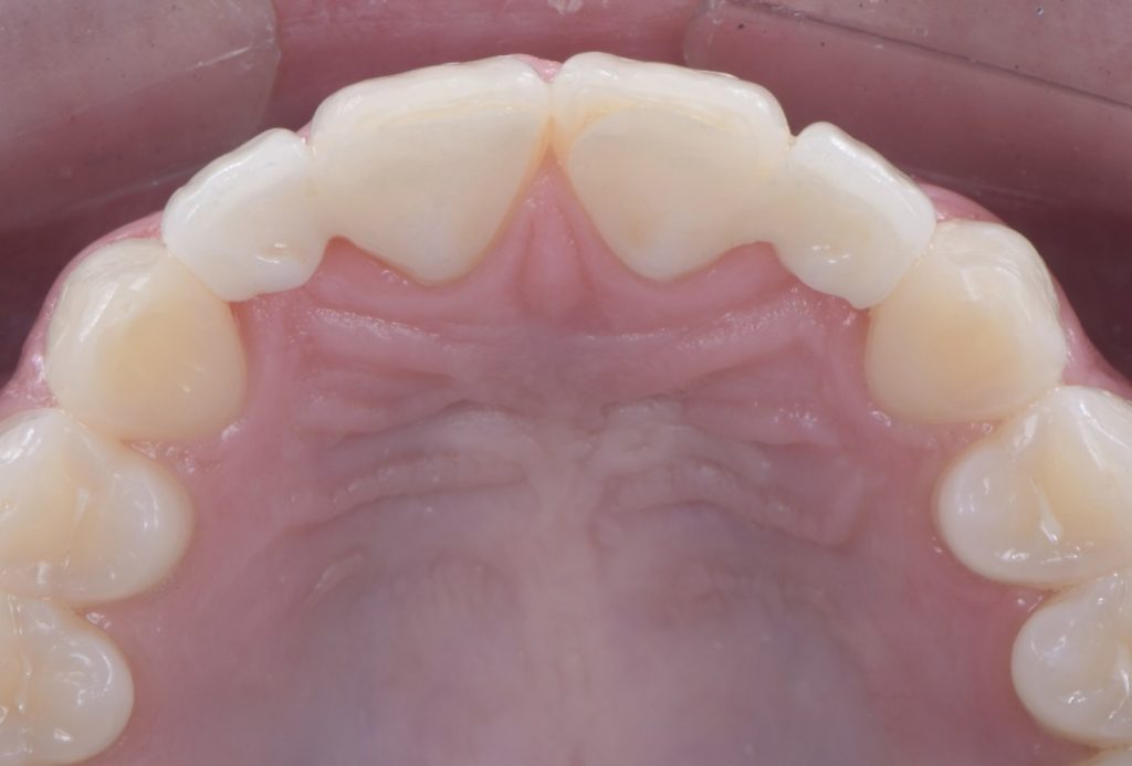 Three Solutions for Congenitally Missing Lateral Incisors: A Photo Essay RicardoMitrani 3SolutionsCongenitallyMissingLats Fig.11