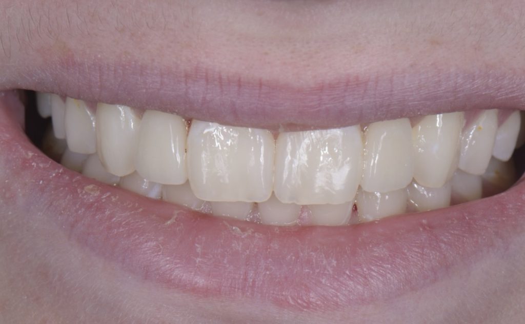 Three Solutions for Congenitally Missing Lateral Incisors: A Photo Essay RicardoMitrani 3SolutionsCongenitallyMissingLats Fig.12