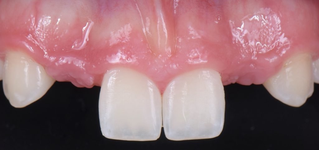 Three Solutions for Congenitally Missing Lateral Incisors: A Photo Essay RicardoMitrani 3SolutionsCongenitallyMissingLats Fig.13
