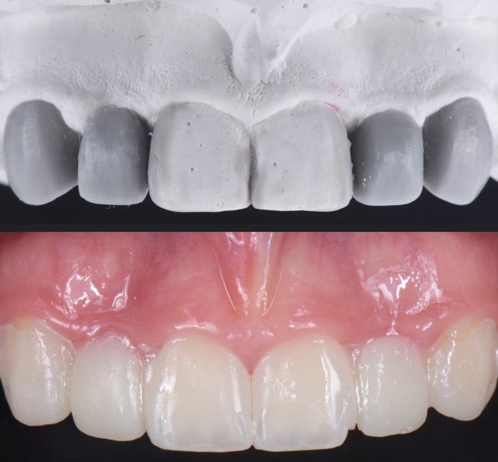 Three Solutions for Congenitally Missing Lateral Incisors: A Photo Essay RicardoMitrani 3SolutionsCongenitallyMissingLats Fig.15