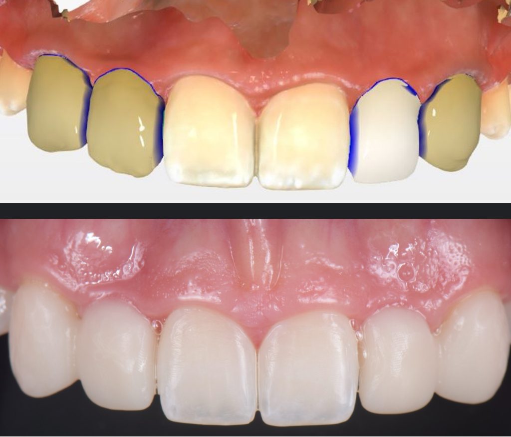 Three Solutions for Congenitally Missing Lateral Incisors: A Photo Essay RicardoMitrani 3SolutionsCongenitallyMissingLats Fig.16