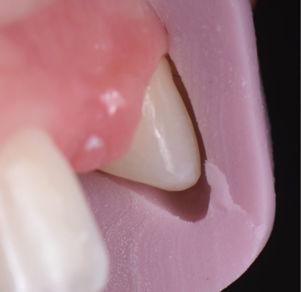 Three Solutions for Congenitally Missing Lateral Incisors: A Photo Essay RicardoMitrani 3SolutionsCongenitallyMissingLats Fig.17