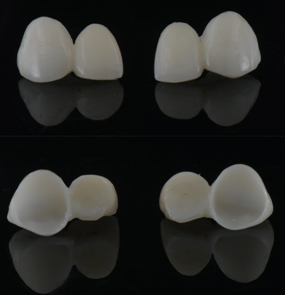 Three Solutions for Congenitally Missing Lateral Incisors: A Photo Essay RicardoMitrani 3SolutionsCongenitallyMissingLats Fig.19