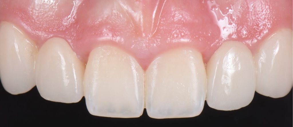 Three Solutions for Congenitally Missing Lateral Incisors: A Photo Essay RicardoMitrani 3SolutionsCongenitallyMissingLats Fig.20