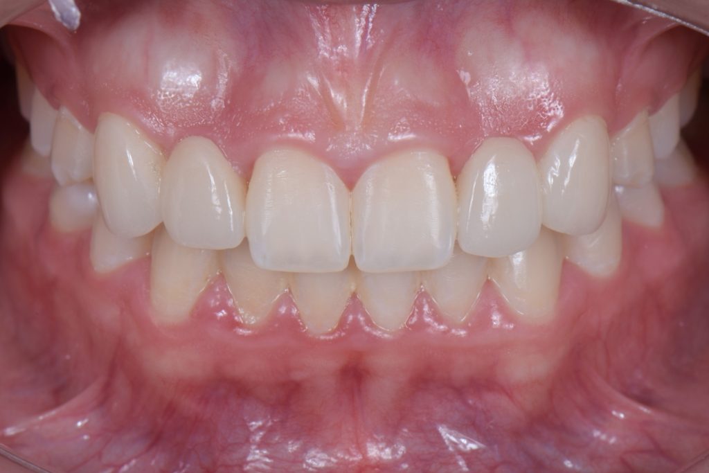 Three Solutions for Congenitally Missing Lateral Incisors: A Photo Essay RicardoMitrani 3SolutionsCongenitallyMissingLats Fig.21