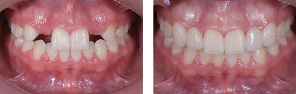 Three Solutions for Congenitally Missing Lateral Incisors: A Photo Essay RicardoMitrani 3SolutionsCongenitallyMissingLats Fig.22